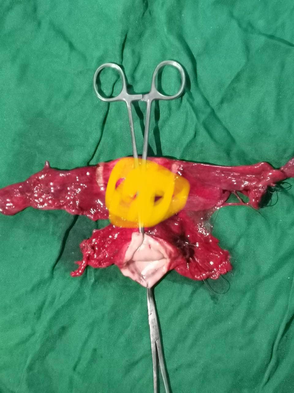 A 55-year-old mother of six presented with three months of vaginal bleeding. Evaluation confirmed early-stage cervical cancer (Stage IB2)