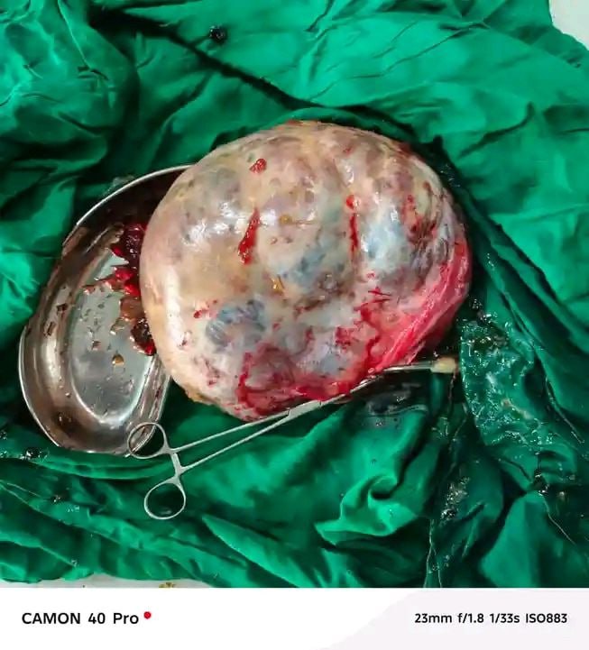 22kg Tumor Removed from a Mother in Successful Surgery